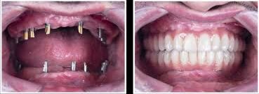 Implante Dentario em Uberlandia  Implante de dente  Extracao de siso  extrir dente siso  colocar dente em Uberlandia  implante dental em Uberlandia  protese dentaria - cirurgiao dentista - Dr Leandro Diniz